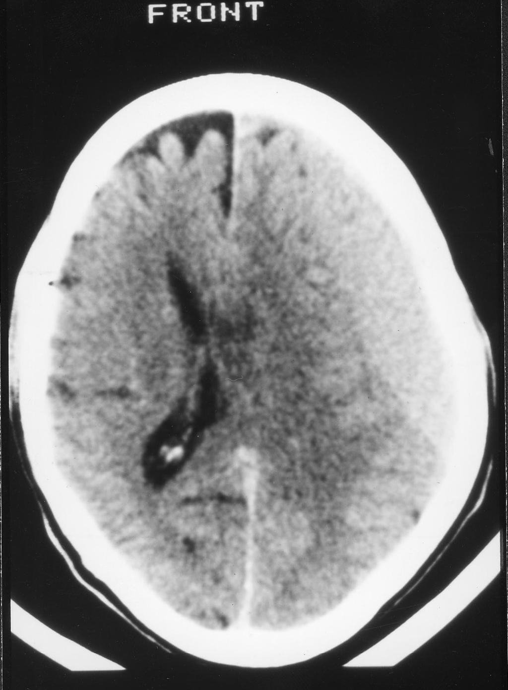Sectc.qxd 29/06/99 09:42 Page 85 CNS haemorrhage Fig. C4 CT scan of the brain. There is an abnormal area of isodense attenuation seen in the left subdural space. This area is not white (i.e. it is not fresh blood).