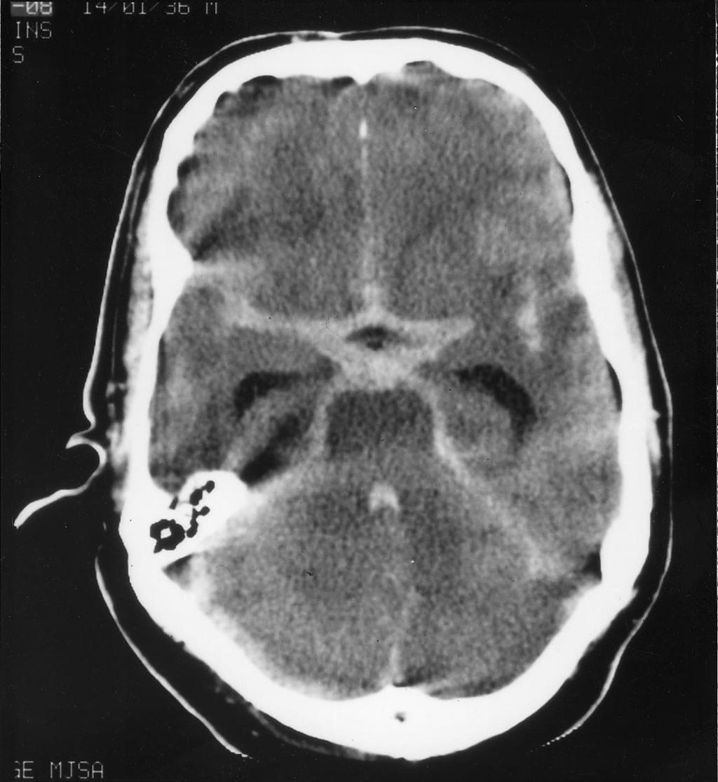 Sectc.qxd 29/06/99 09:42 Page 87 Subarachnoid haemorrhage The patient presented with a sudden onset of headache. Subarachnoid haemorrhage Fig.