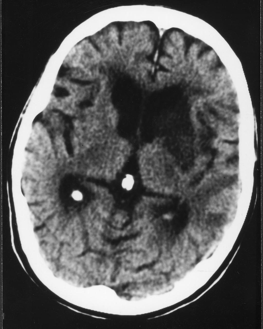 Sectc.qxd 29/06/99 09:43 Page 88 The central nervous system Cerebral infarction Fig. C7 CT scan of the brain showing a section at the level of the thalamus. There is a generalized atrophy noted.
