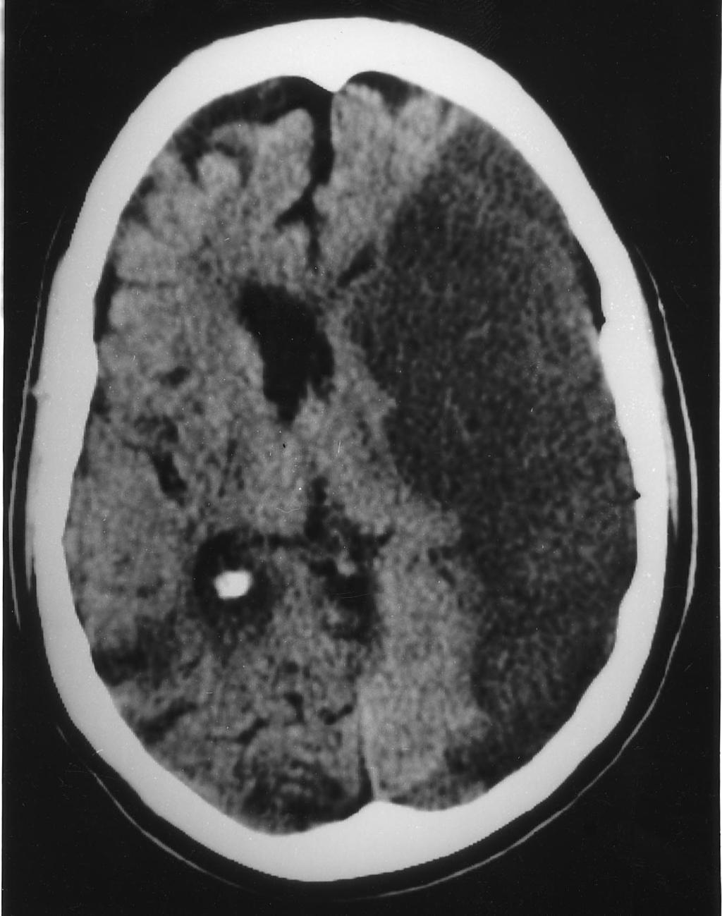 Sectc.qxd 29/06/99 09:43 Page 89 Cerebral infarction Fig.