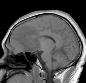 MRI 12/31/2014 Extra-axial lesion involving the