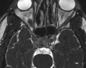 MRI 01/13/2015 Focal areas of