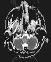 MRI 11/29/2014 Mass along the inferior aspect