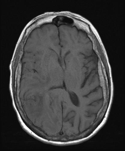 MRI 01/15/2015 Ill-defined right parieto-occipital