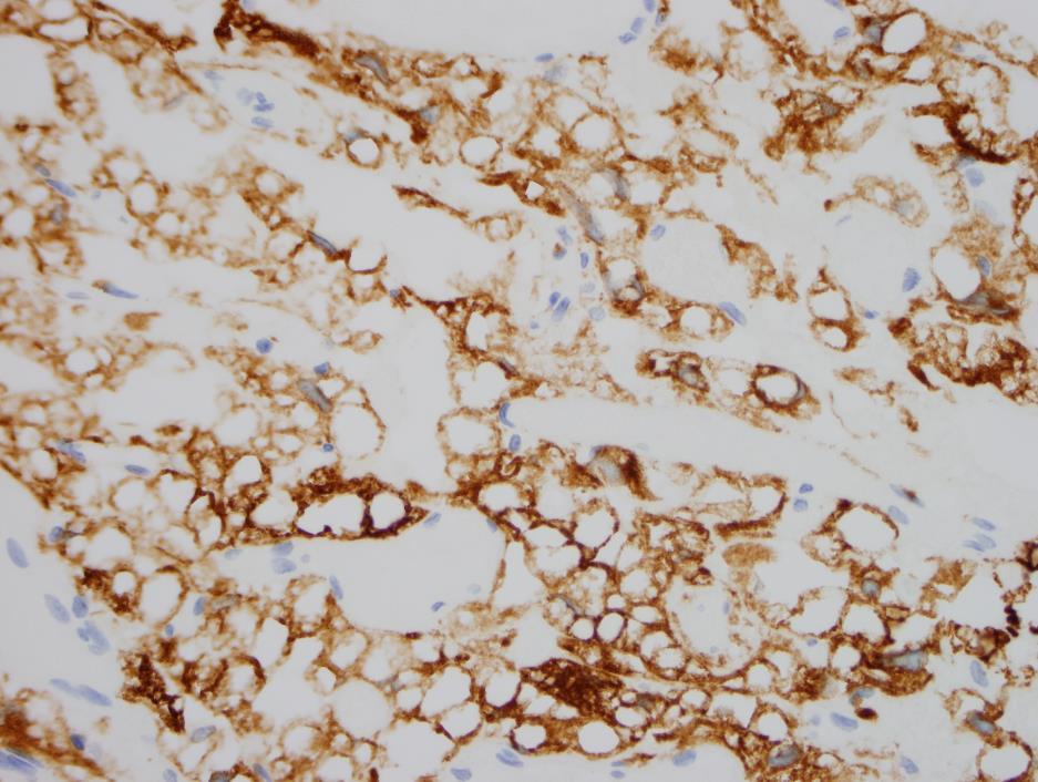 Inhibin Negative markers: GFAP not a hypervascular glial tumor EMA not a meningioma (angiomatous or