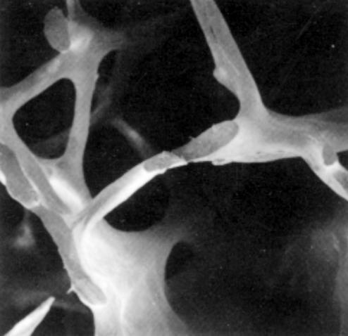 Osteoporosis is a condition