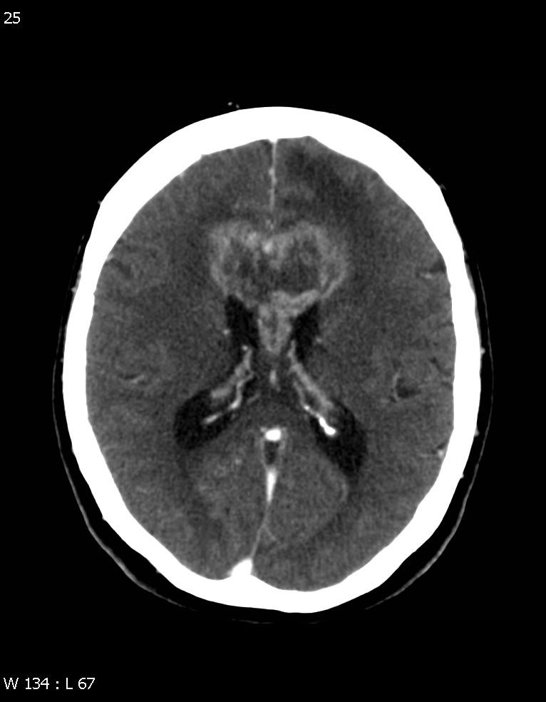 Glioblastoma Multiforme Rapidly enlarging malignant astrocytic tumor characterized by necrosis and neovascularity WHO grade IV Most common primary brain tumor Supratentorial white