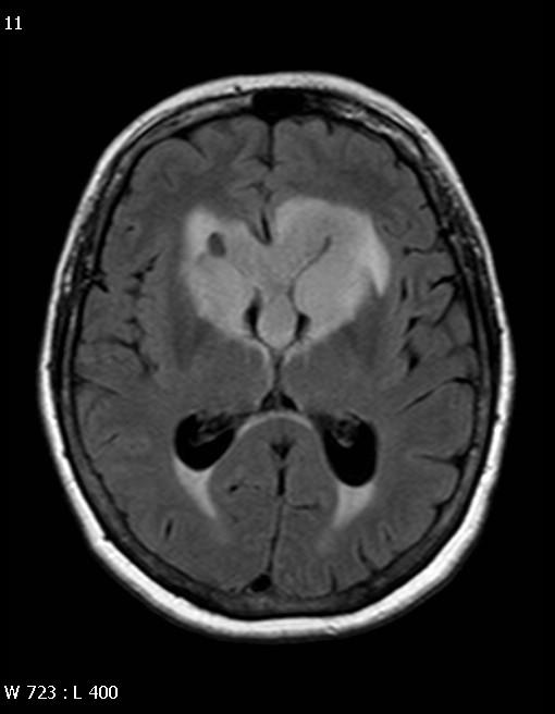 Glioblastoma Multiforme Neuroimaging: Thick, irregular-enhancing rind of neoplastic tissue surrounding necrotic core Tumor typically crosses WM tracts to involve contralateral hemisphere Rarely may