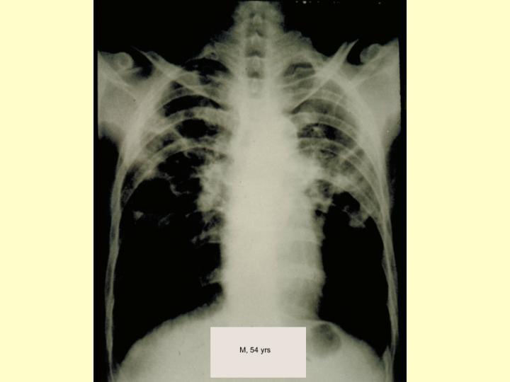 Pulmonary TB