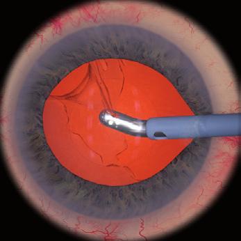 Cataract Surgery Training Practice all Steps of Intraocular Cataract Surgery Taking the Patient Out of the Surgical Learning Loop Eyesi Surgical is a high-fidelity