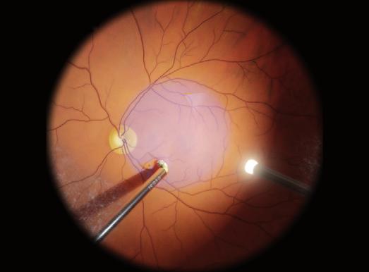 Reasons for Eyesi Surgical Peer-Reviewed Intraocular Surgery Training with Validated Concept 1 2 3 Less Complications in Intraocular Surgery The Eyesi Surgical Simulator is a technically mature