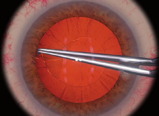 Several studies prove that unexperienced surgeons who trained on Eyesi Surgical have lower complication rates during intraocular surgery than peers who did not have the opportunity to train on Eyesi