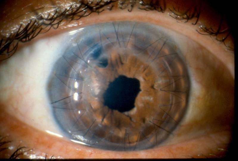 Anterior Segment Reconstruction with Iris Repair