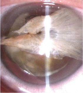 extent and location of iris tissue loss, patient