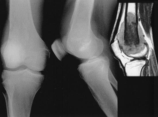 Number 384 March, 2001 Knee Reconstruction 209 MATERIALS AND METHODS Between 1992 and 1997, nine patients underwent fully constrained prosthesis and muscle transfer reconstruction of the knee after