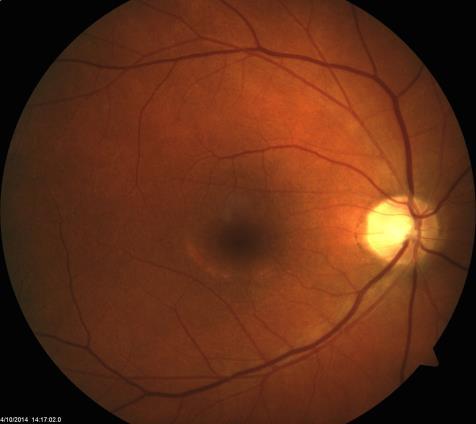 Potential for changes to cornea or optic nerve Potential for deposition in macular region More common