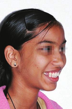 CASE REPORT A 17-year-old girl reported with a chief complaint of proclined anteriors.