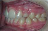 The absence of a canine bulge and the presence of a bilateral palatal bulge were noted upon intraoral palpation. There were no symptoms.