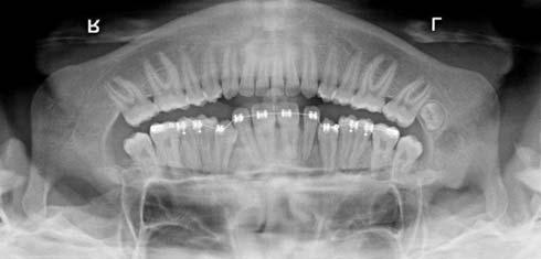 when the degree of overlap between the permanent maxillary cuspid and m the neighboring lateral incisor exceeds half the width of the incisor root, the chances of complete recovery are poor.