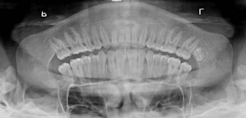 Figure 2d: Panoramic radiograph taken during Treatment after 18months (final). A B C Figure 3a-c: Final intraoral views.