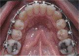 Appt. 4 8 months 3 weeks: Placed maxillary and mandibular.018 x.025 NiTi SE. In crowded cases, an archwire sequence of.014 NiTi to.014 x.