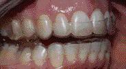 026 steel round bonded to all teeth cuspid to cuspid due to the severity of crowding. 3.