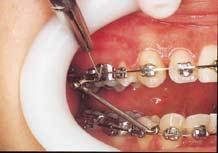 16). When the MPA IV is inserted from the distal of the maxillary first molar tube, as shown above, the T tube is