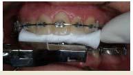 Prepare for Archwire Disengagement Remove any bendbacks distal to the molars For sensitive patients use a cotton roll Have the patient