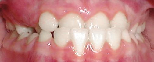 III malocclusion in