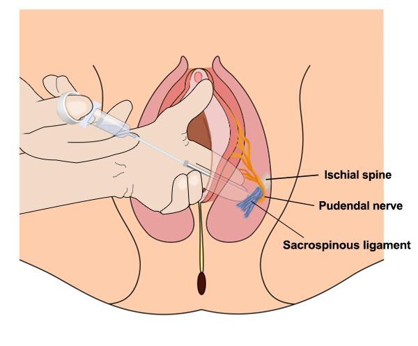 Pudendal Nerve Block The sensory and motor innervation of the perineum is derived from the pudendal nerve, which is composed of the anterior primary divisions of the second, third, and fourth sacral