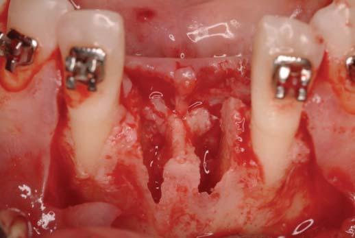 RapidSorb Surgical Treatment The surgical site was accessed via sulcular incision from the distal of the adjacent teeth, with vertical releases on the distolingual.