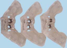 The results verified that the single RapidSorb mesh and bone grafting surgery provided adequate bone augmentation for the patient to undergo flapless implant surgery and avoid additional grafting.