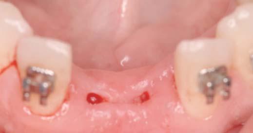 0 mm, to provide acceptable interimplant and tooth-implant distances.