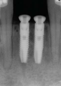 RapidSorb Rapid Resorbable Fixation System. Discussion Alveolar ridge augmentation is often required to enable the desired placement of dental implants.