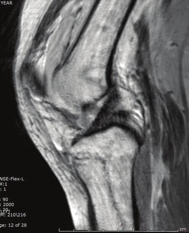 Figure 2: Initial CT scans of left tibia