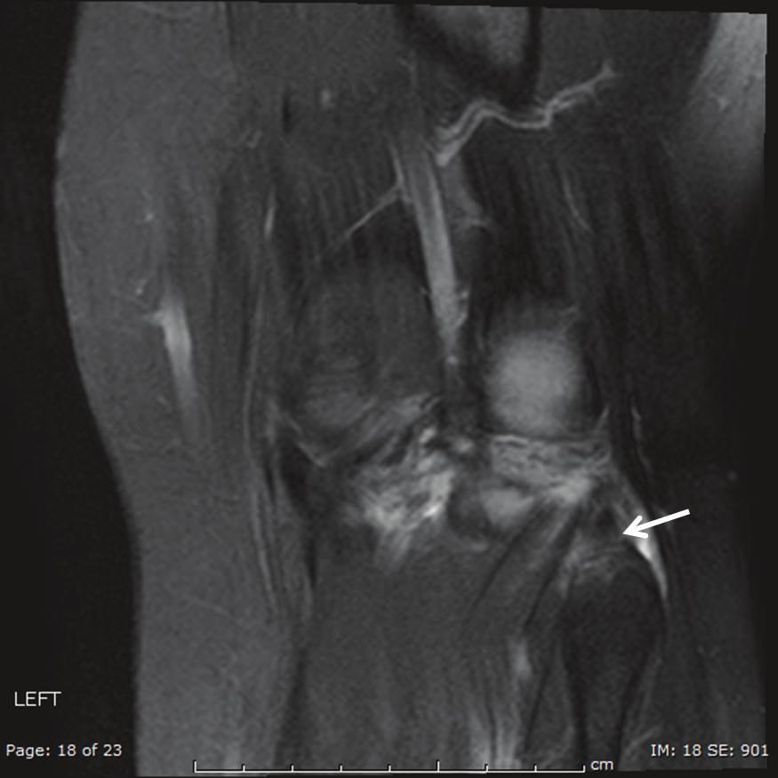 Case Reports in Orthopedics 3 (c) Figure 4: MRI of left knee showing popliteofibular ligament tear and edema in fibular styloid (arrow, ), attenuated LCL (arrow, ), and popliteus tendon signal