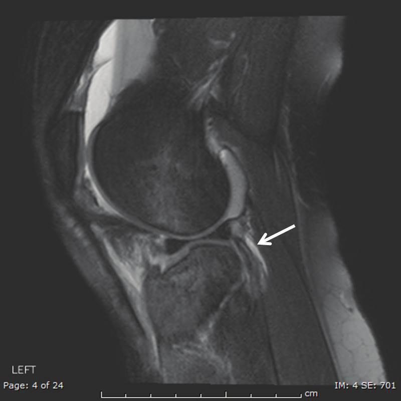 A formal lateral dissection was performed and the peroneal nerve was protected and identified. The LCL had completely avulsed off the fibular head but remained firmly attached to the femur.