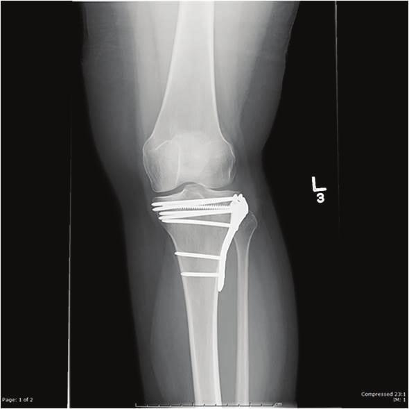 4 Case Reports in Orthopedics Figure 5: AP and lateral plain radiographs at sixteen months postoperatively. tibial plateau fractures.