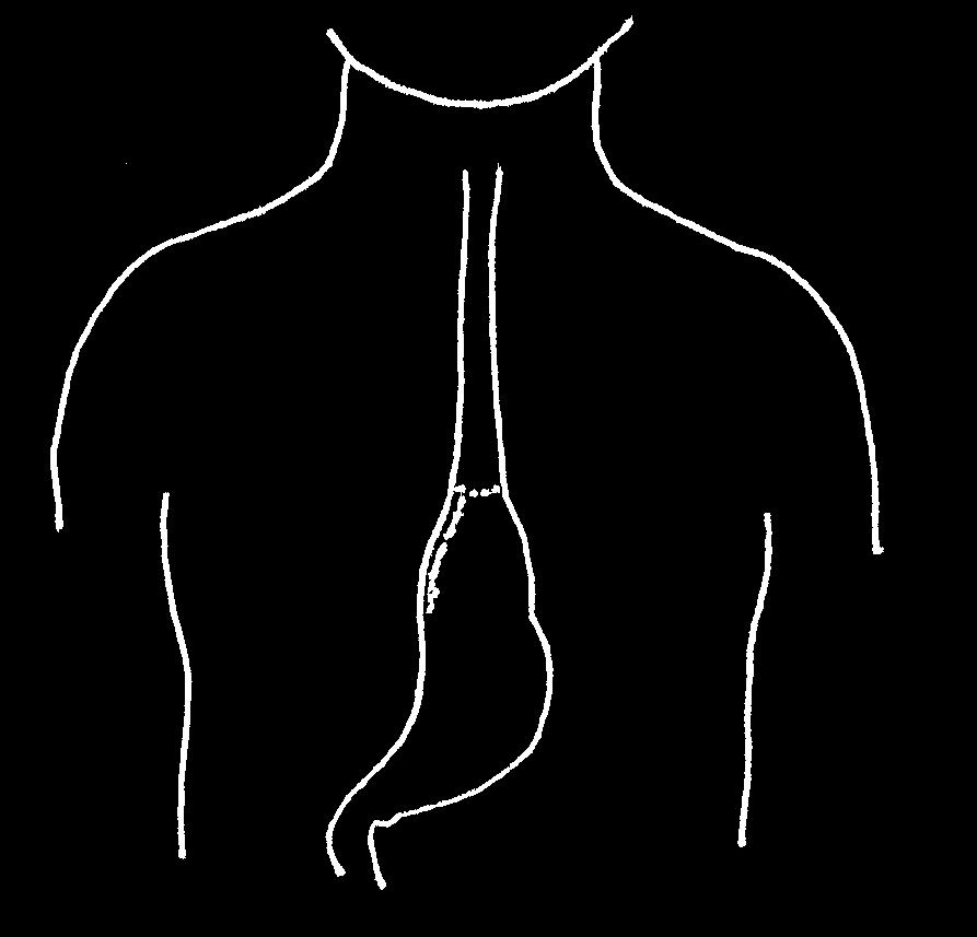 The part of the esophagus that is removed