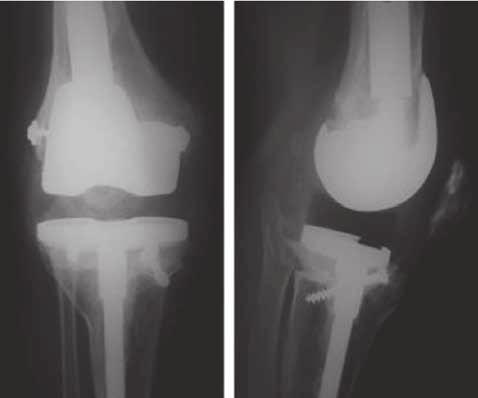 Preoperative anteroposterior (A) and lateral (B) radiographs of a right knee demonstrating an AORI type-3 femoral defect obtained eight years after