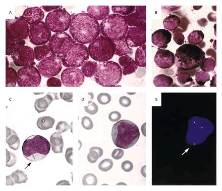 Acute myeloid leukemia Patient