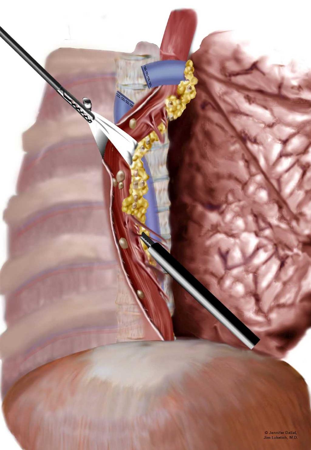 Minimally Invasive Esophagectomy N=222 1996 2002 47 HGD & 175 Cancer Induction in 35% Conversion 7.