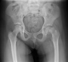 SCFE DISRUPTION AT THE GROWTH PLATE THAT LEADS TO DISPLACEMENT OF THE PROXIMAL FEMORAL HEAD. CC: GROIN, HIP, THIGH OR KNEE PAIN PT: OBESE, ADOLESCENT (10-14 Y.O.) MALE (3:2 RATIO) PE: LOSS OF HIP INTERNAL ROTATION, ABDUCTION, AND FLEXION OBLIGATORY EXTERNAL ROTATION DURING PASSIVE FLEXION XR: BILATERAL AP AND FROG LEG.