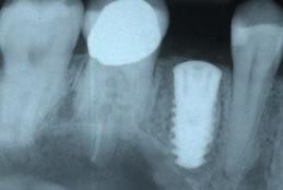 vertical bone changes, registered with a surgical stent positioned on the adjacent teeth and measured with a Williams periodontal probe soon after the tooth extraction and at the time of implant