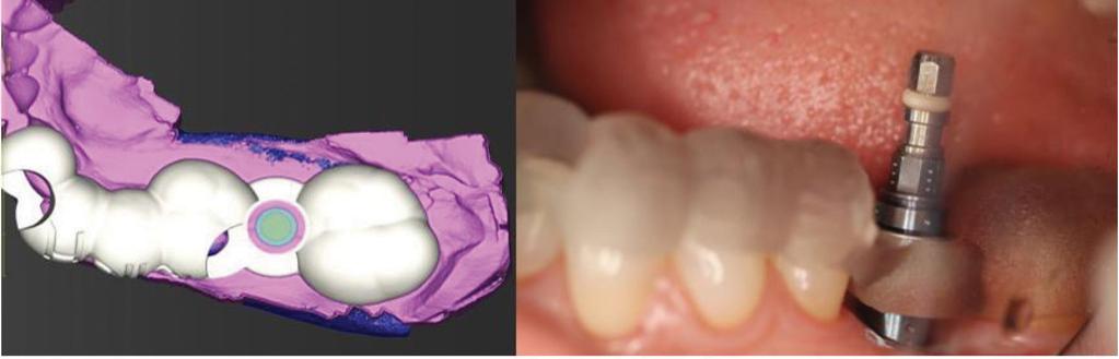 Figure 3. Virtually designed surgical guide (left) and surgical guide utilized for implant placement (right) Figure 4.