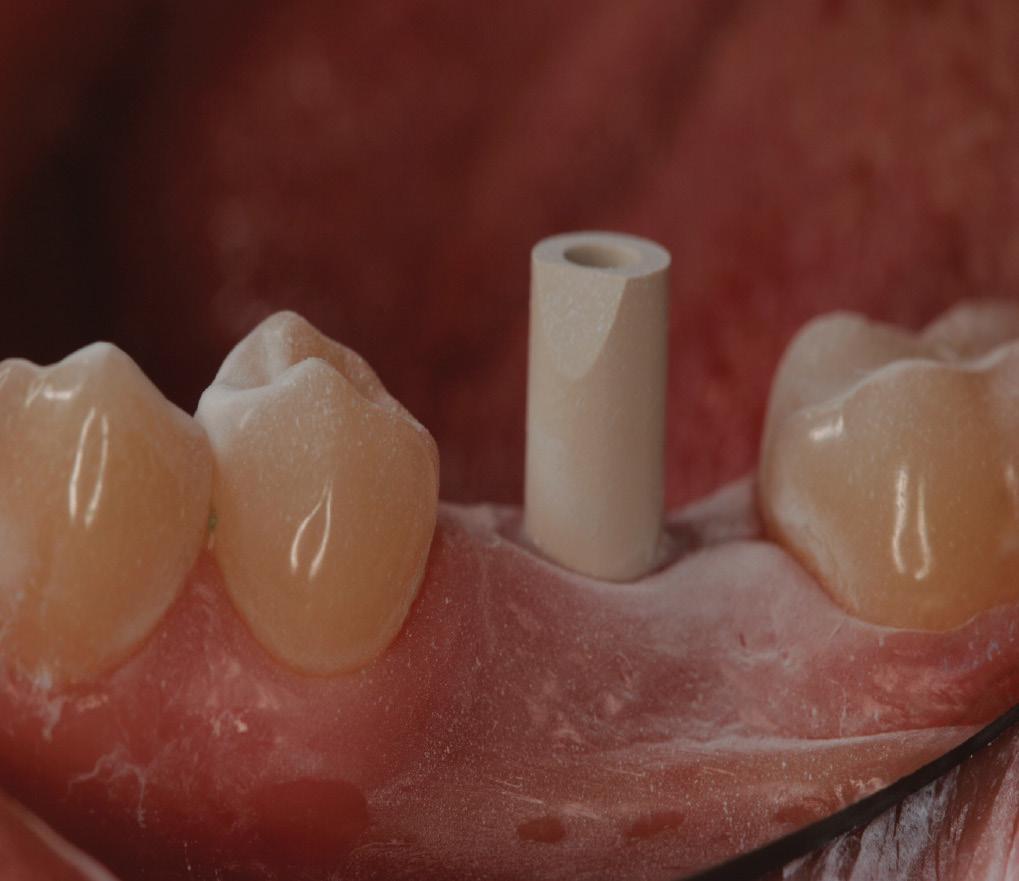 This process enabled the students to ensure that their implant planning was prosthetically driven.