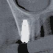 Implant Placement Dr.