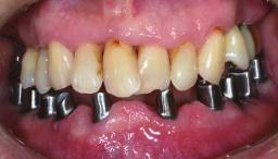 mobility due to occurrence of periodontal