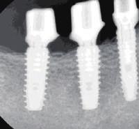 Implant Planning-1 Implant Planning-2 Post