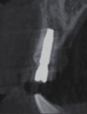 After implant placement, panorama and CBCT